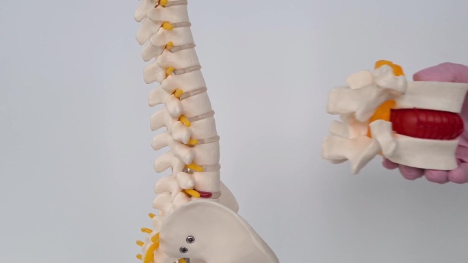 医生的手有一个人工椎间盘突出和一个脊柱模型