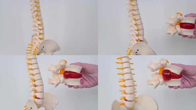 医生的手有一个人工椎间盘突出和一个脊柱模型