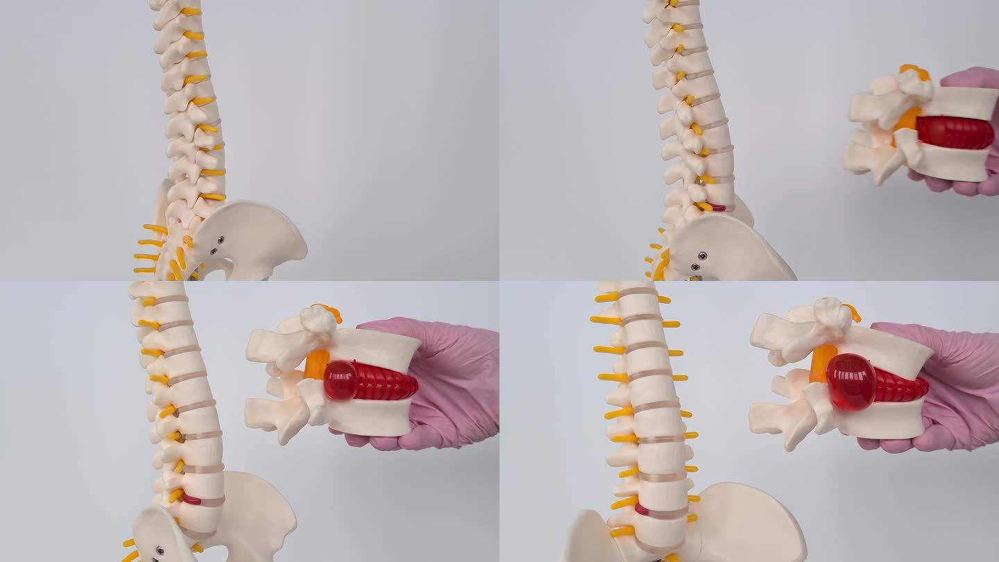 医生的手有一个人工椎间盘突出和一个脊柱模型