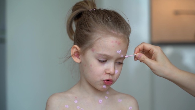 母亲将药膏涂抹在患水痘的患病女孩的脸上