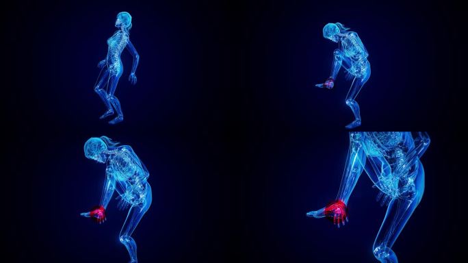 足底筋膜炎4K抽象动画