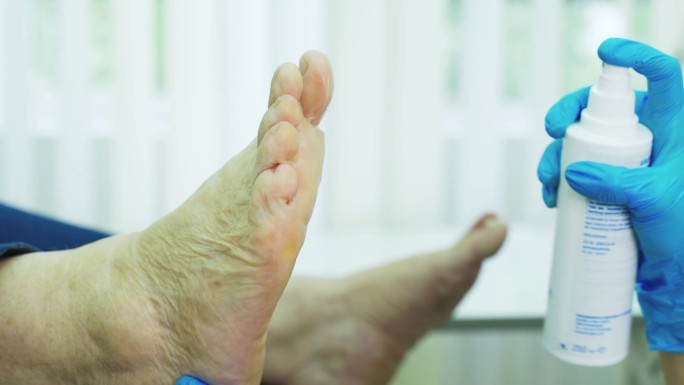 骨科医生用杀菌剂治疗脚的表面。