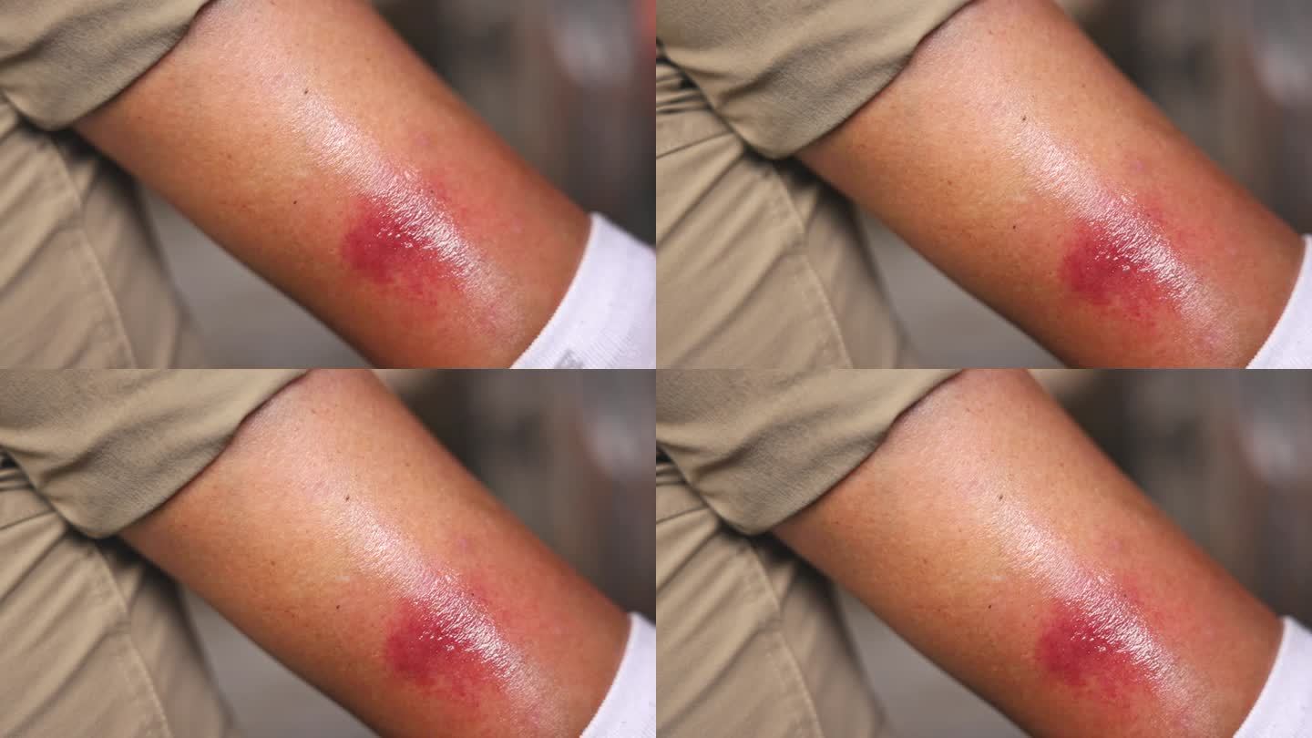 特写——女人腿上的虫咬……腿上有红色的咬痕。瘙痒和炎症。