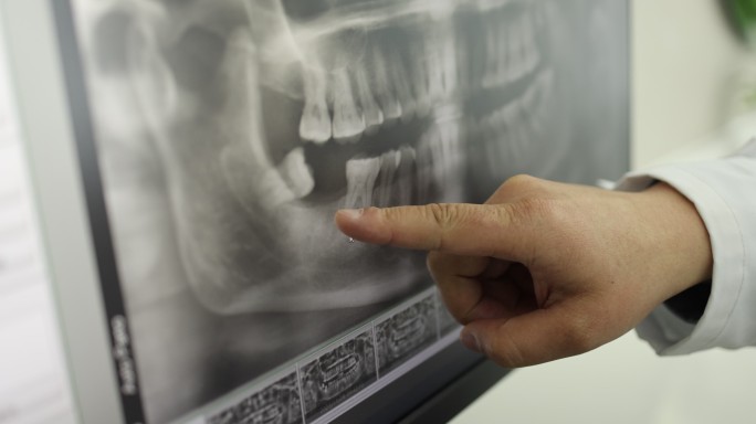 口腔影像CBCT图片牙科种植牙位置讲解