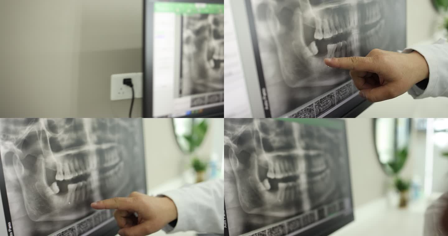 口腔影像CBCT图片牙科种植牙位置讲解