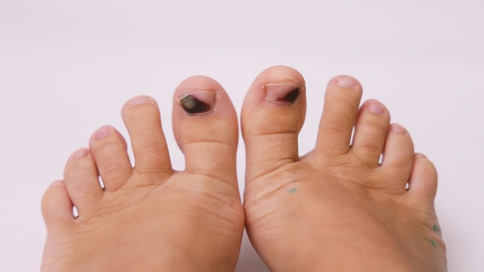 跑步者的脚趾甲上有血肿。穿不舒服的鞋或被撞的后果。