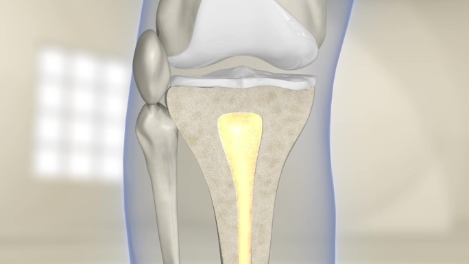 骨髓缺失和修复 关节 关节炎