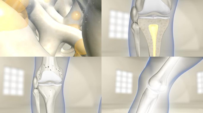 骨髓缺失和修复 关节 关节炎