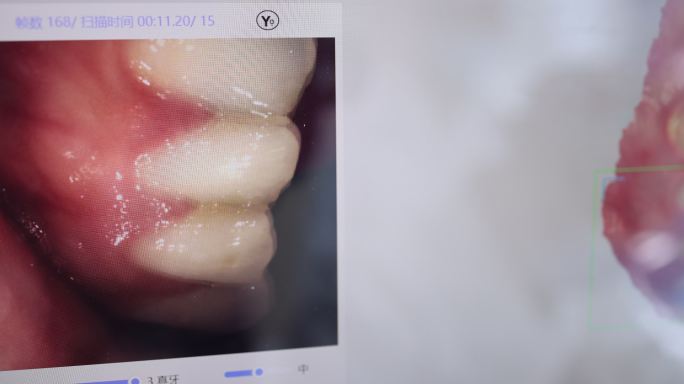 口腔扫描口内3D扫描仪屏幕牙医种植牙手术