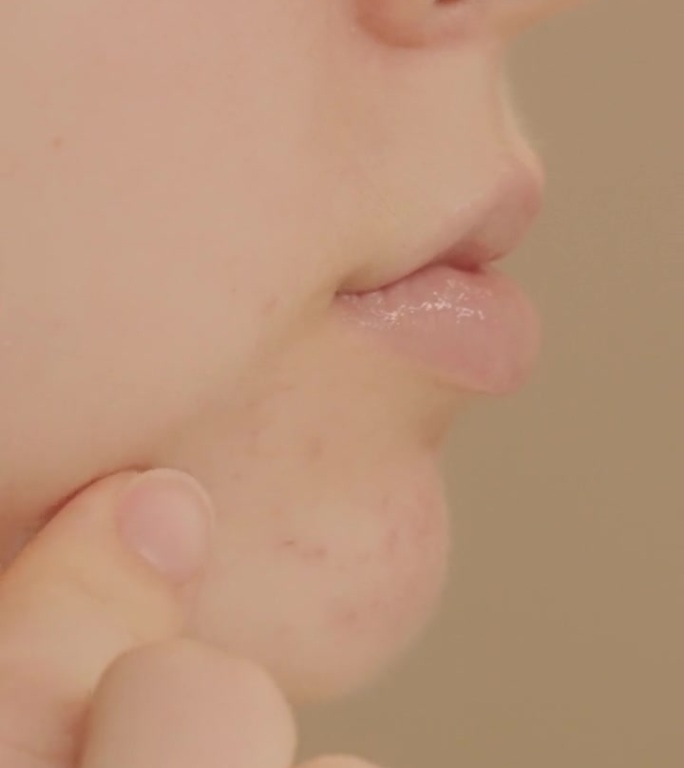 年轻女子在脸上的痘痘上贴了一块贴片。解决痤疮问题。