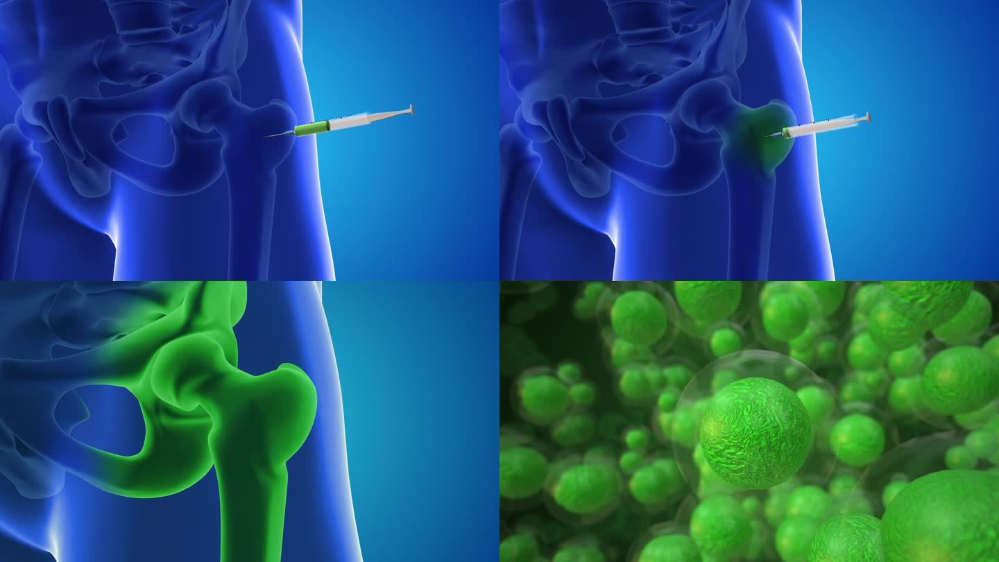 一个动画显示干细胞被注入大腿