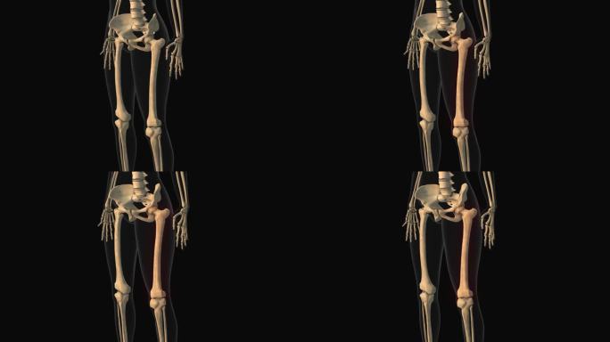 大腿骨疼痛的医学动画