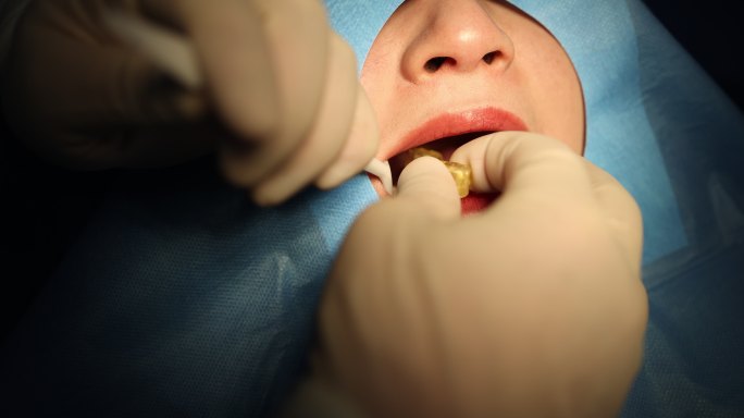 牙科口腔诊所种植牙手术口内佩戴种植导板