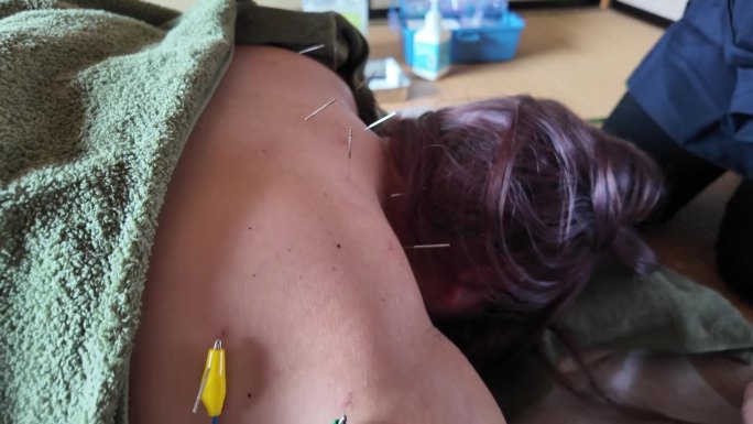 一名女性患者的肩膀和手臂上的针灸针上安装了电夹子