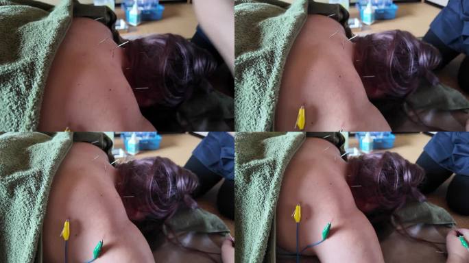一名女性患者的肩膀和手臂上的针灸针上安装了电夹子