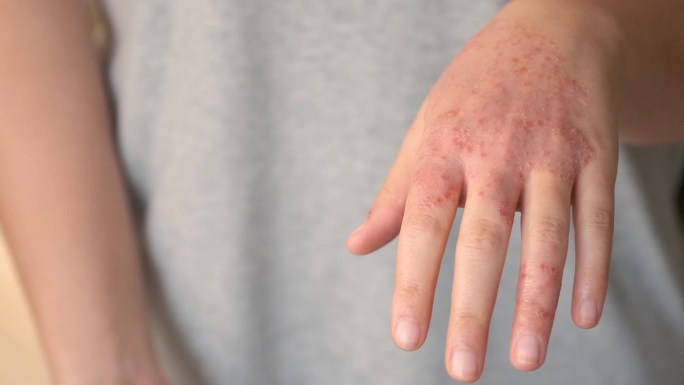 不可识别的妇女与补充或药物治疗湿疹在手。