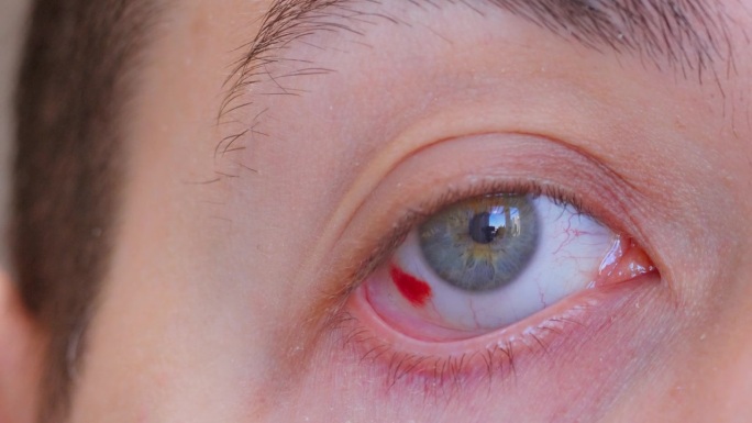 充血的眼睛。伙计，一个红红的，流血的眼球。眼睛受伤流血。有选择性的重点