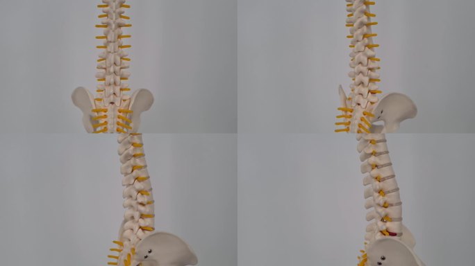 腰椎移位，椎间盘碎片突出，脊神经和骨头突出