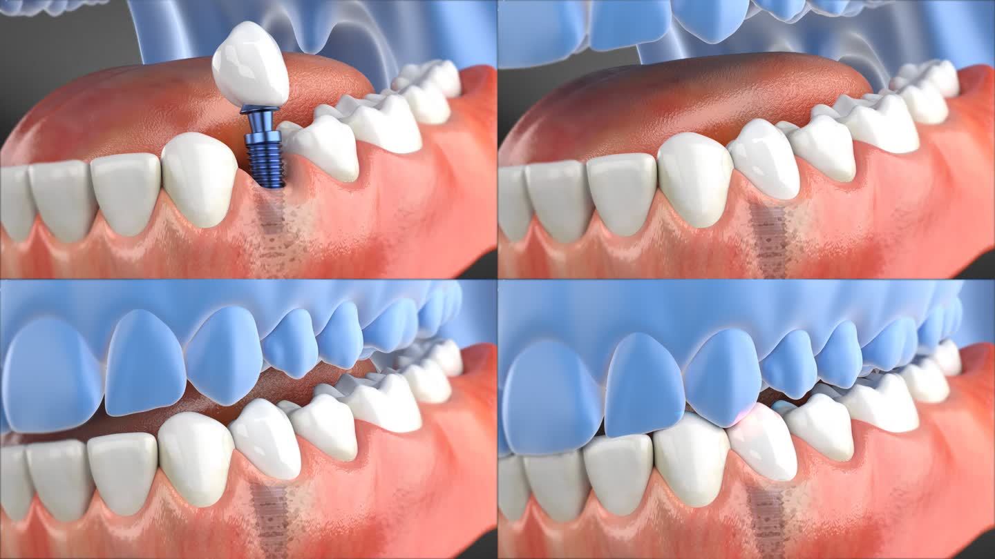 AE种牙 种植牙 牙齿矫正 牙齿健康