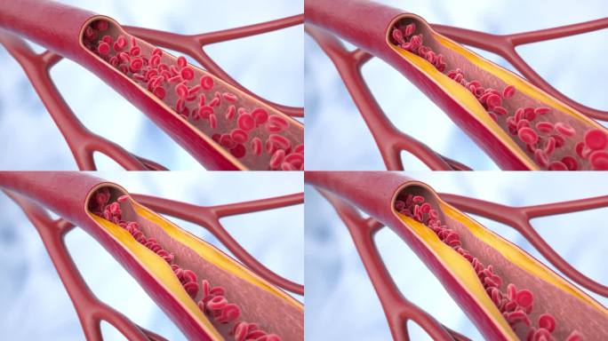动脉粥样硬化疾病。血管中的胆固醇