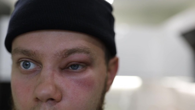 一名男子在挨打和拳击后脸上有淤青。戴墨镜的男人脸