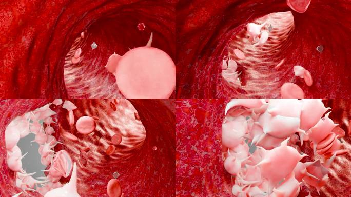 止血。血管中的红细胞和血小板，血管收缩，伤口愈合过程。血块栓塞，血友病。纤维蛋白溶解，损伤出血凝血，