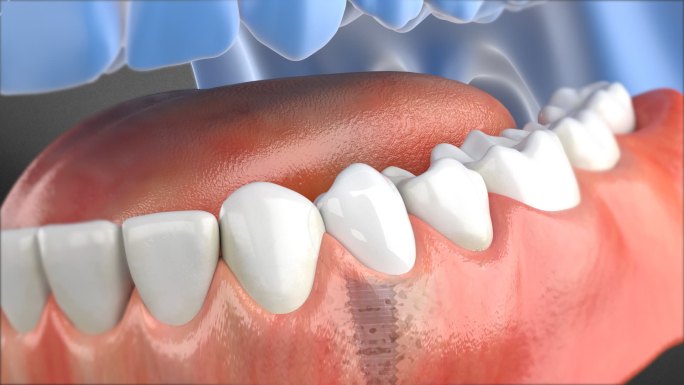 种植牙受力不均 牙齿受力不均
