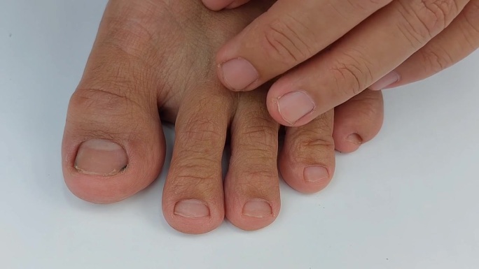 由于瘙痒，皮肤干燥，脚部真菌导致的手在脚趾间抓挠的孤立特写镜头