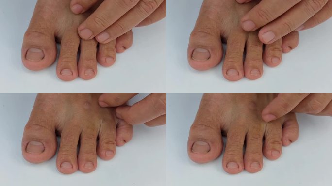 由于瘙痒，皮肤干燥，脚部真菌导致的手在脚趾间抓挠的孤立特写镜头