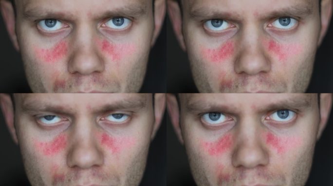 红斑狼疮是一种自身免疫性疾病症状表现为脸部发红