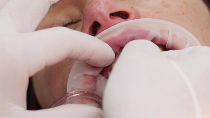 女性患者在安装氧化锆贴面过程中的特写镜头。在现代牙科诊所里，牙医用手给妇女的牙齿戴上白色的贴面。安装