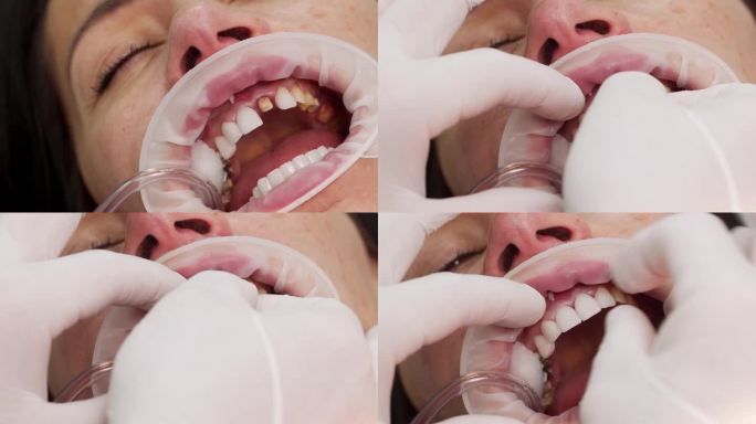 女性患者在安装氧化锆贴面过程中的特写镜头。在现代牙科诊所里，牙医用手给妇女的牙齿戴上白色的贴面。安装