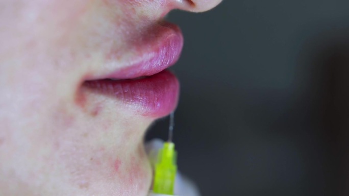 美容医生在年轻美女的嘴唇上注射肉毒杆菌的垂直镜头。极致的近距离4k拍摄