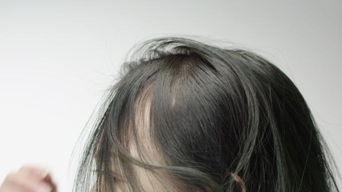 脱发 发际线后移 头发问题6