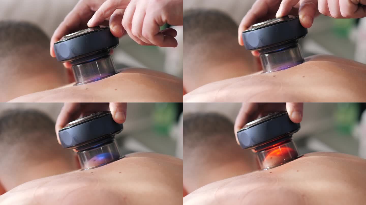 现代电子真空杯在病人背部皮肤水疗按摩沙龙。真空拔罐是一种古老的替代疗法。中药