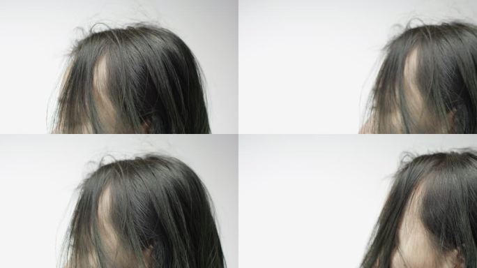 脱发 发际线后移 头发问题10