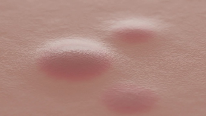粉刺会突然出现在脸部皮肤上。丘疹造成