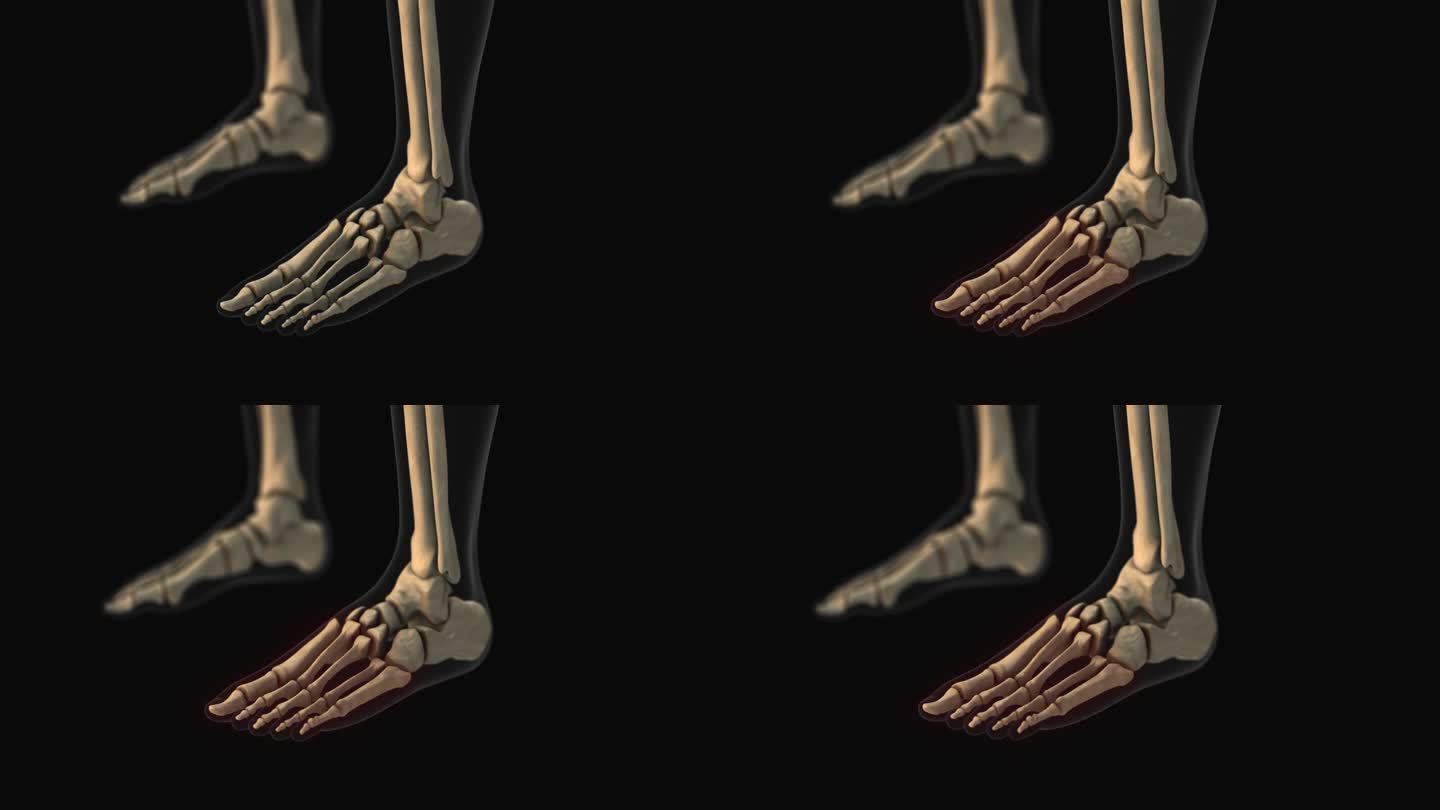跖骨和指骨骨痛的医学动画
