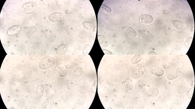 显微镜下人类尿液标本中的血吸虫卵。尿寄生虫