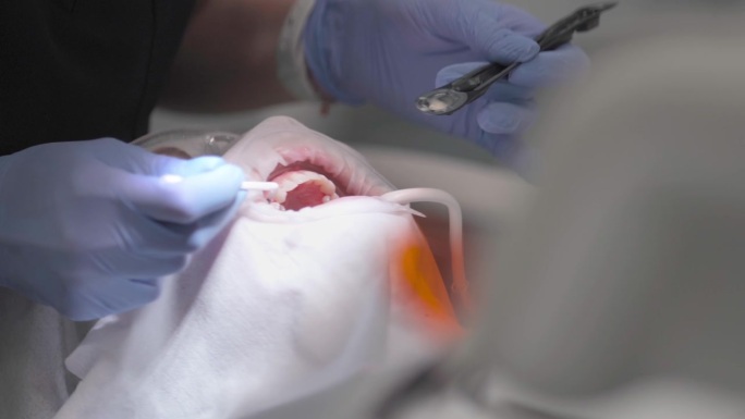 牙医会在清除牙垢后，在牙齿上涂上氟化物清漆。