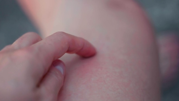 昆虫叮咬或受感染的微生物渗透后，在人体皮肤上形成红痒斑。皮肤发红、发炎，对人体有刺激和过敏反应，对人
