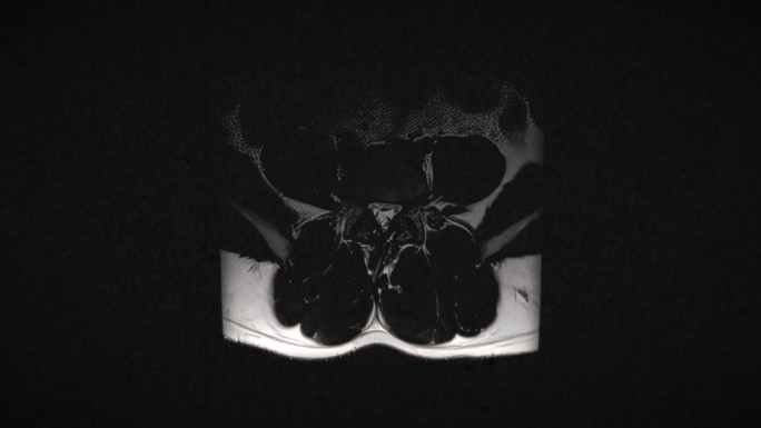 由于过度举重训练导致腰椎间盘突出的男性腰椎的粗糙和高度纹理的复古MRI扫描。从上到下扫描