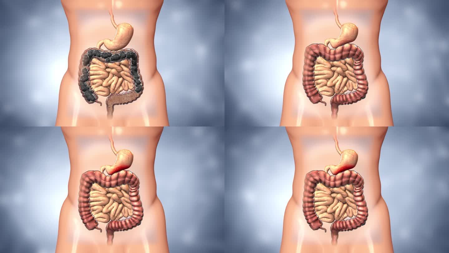 囤积许多粪便的肠道会压迫到胃肠胃蠕动变慢