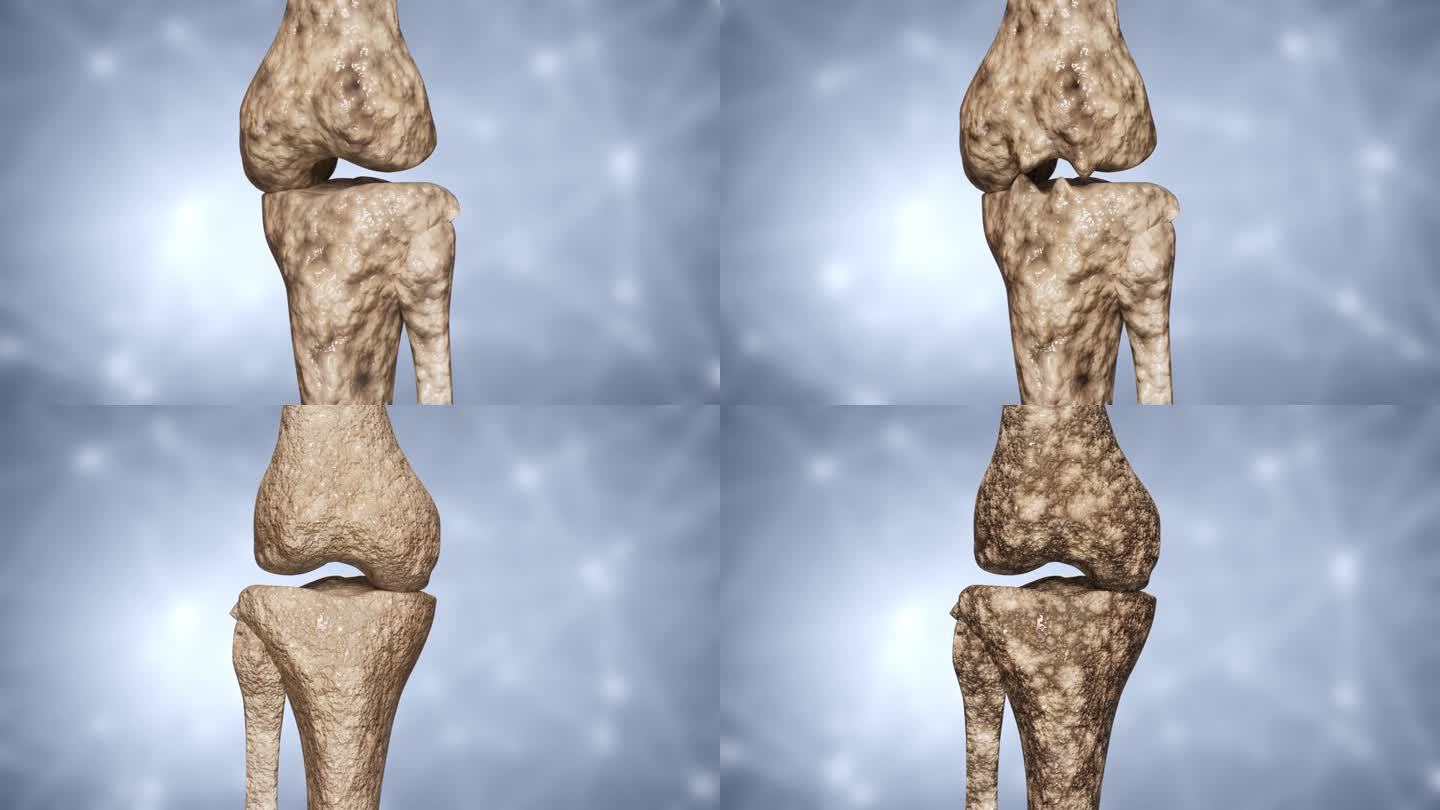 骨质增生形成过程+骨质疏松形成过程