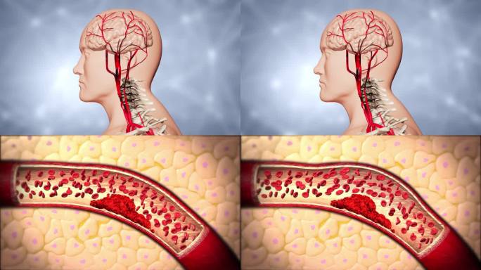 颈椎病，长期会影响大脑供血不足，导致头晕