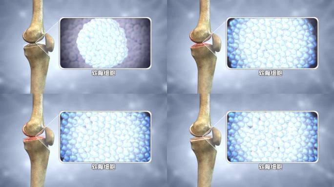 软骨修复的那种