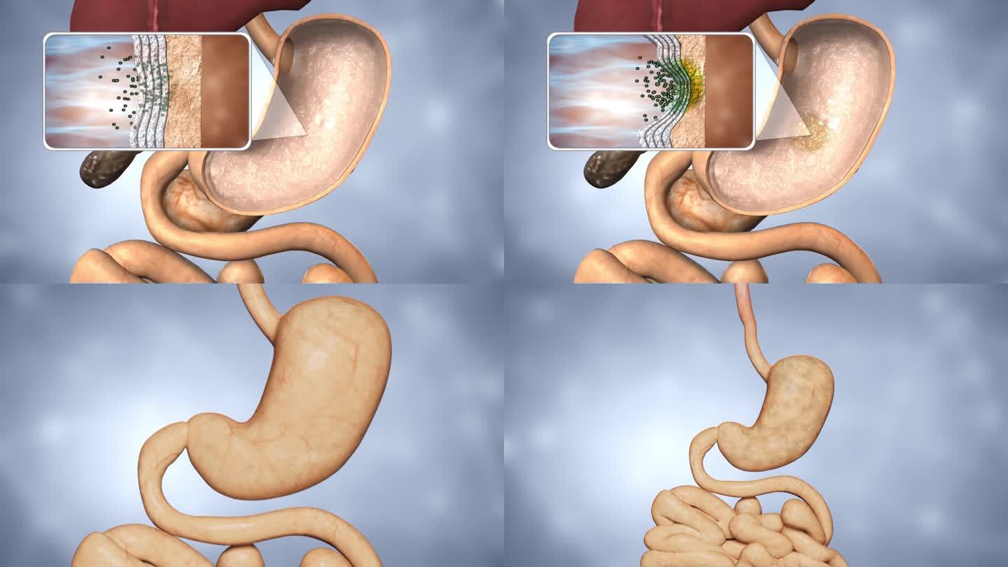 细菌侵蚀胃黏膜 胃黏膜特写拉出到整个肠胃