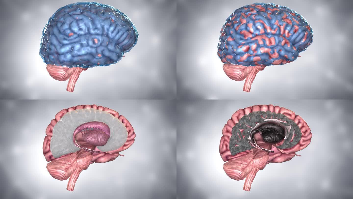 脑髓减少了脑细胞，脑白质，脑灰质