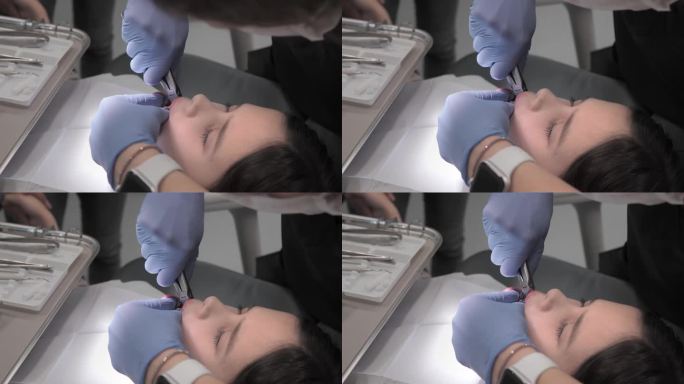 儿科牙医用镊子松开并取出婴儿的乳牙。