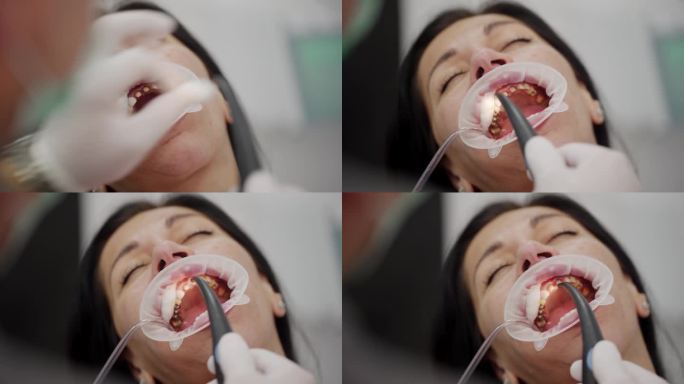 女性患者烤瓷牙冠粘接预备。在安装氧化锆贴面前进行牙齿喷涂和清洁。牙医正在洗掉女人牙齿上的蓝酸。特写镜